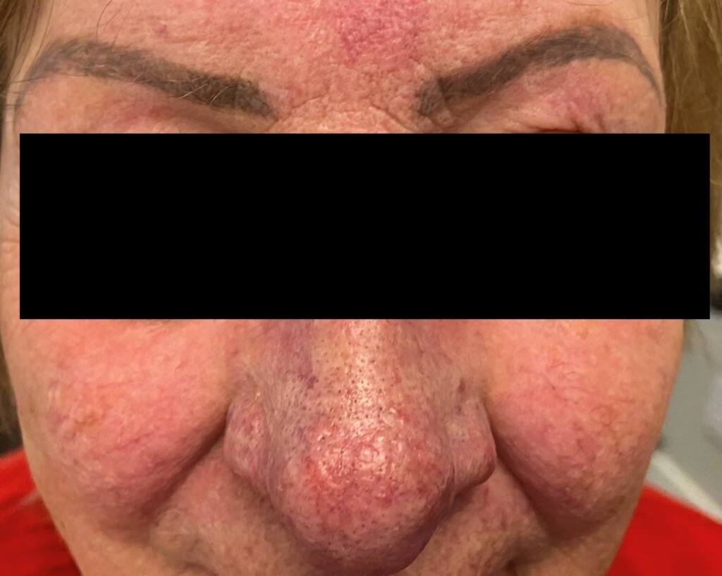 rosacea ocular rosacea ocular